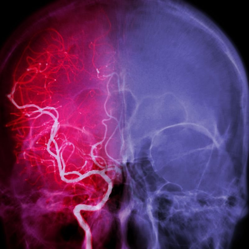 Aneurisma Cerebral