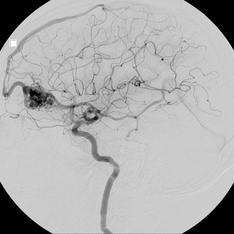 Malformación Arteriovenosa (MAV)