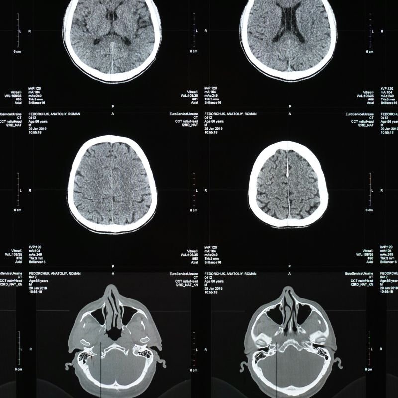 Meningitis e Infecciones Cerebrales