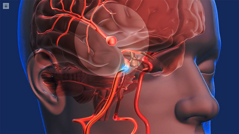 Lee más sobre el artículo ¿Cuáles son los síntomas de un aneurisma cerebral?